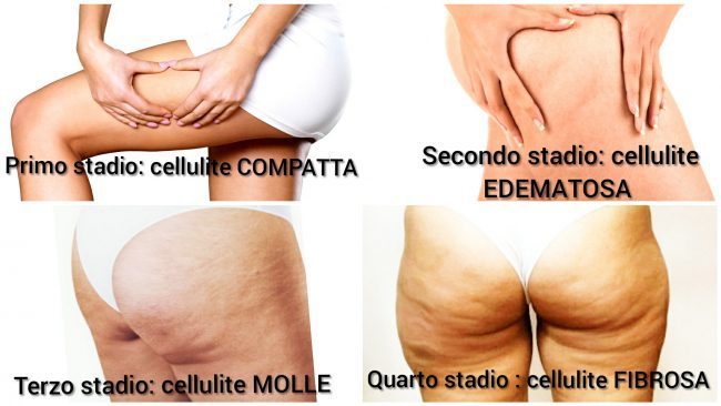I 4 stadi della cellulite