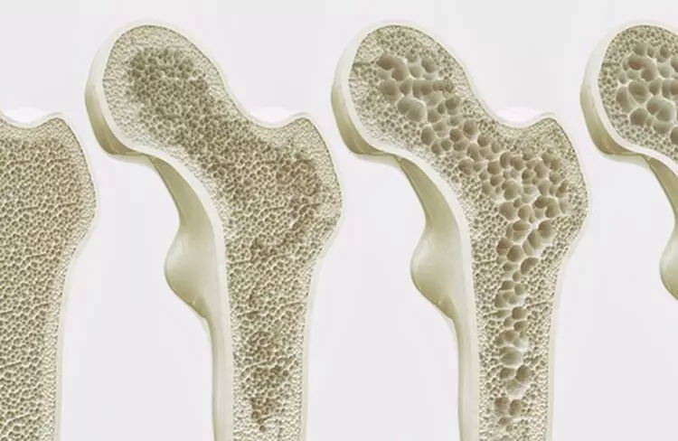 Tipi di osteoporosi